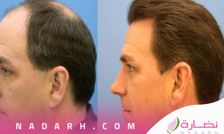 افضل مراكز زراعة الشعر في تركيا