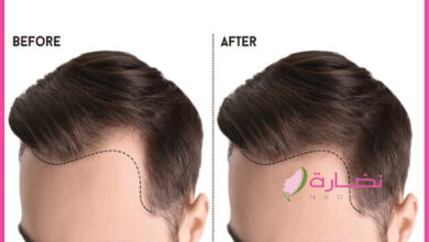 زراعة الشعر في تركيا