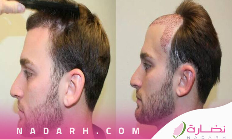 تجربتي مع زراعة الشعر في الرياض