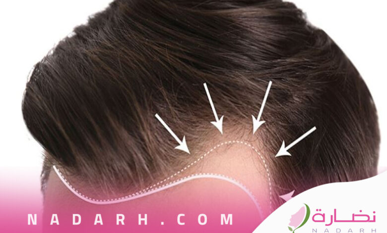 تكلفة زراعة الشعر في السعودية