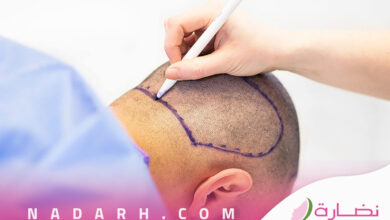 زراعة الشعر بالتقسيط في السعودية