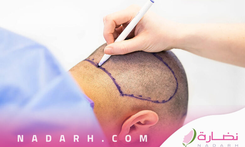 زراعة الشعر بالتقسيط في السعودية