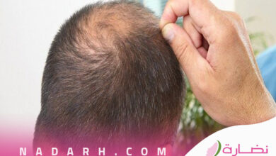 زراعة الشعر في السعودية جدة