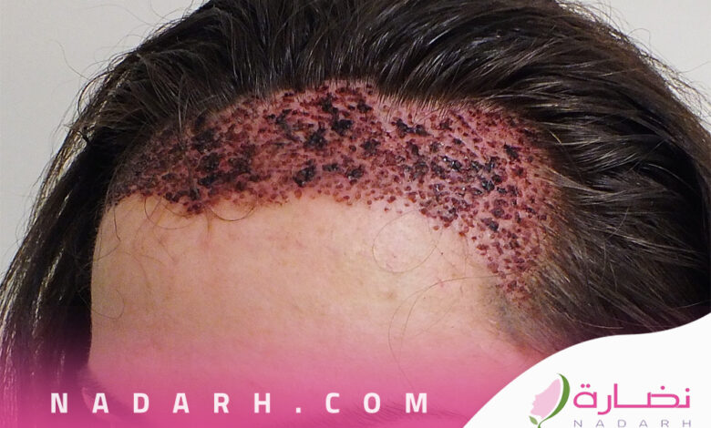 عملية زراعة الشعر