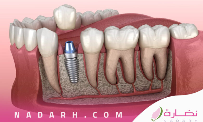 عيوب زراعة الاسنان الفورية